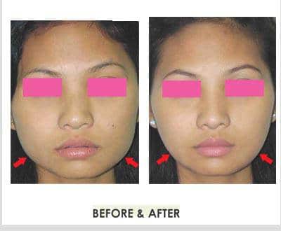 Chin Contouring and Chin Reduction – Plastic Surgery Thailand