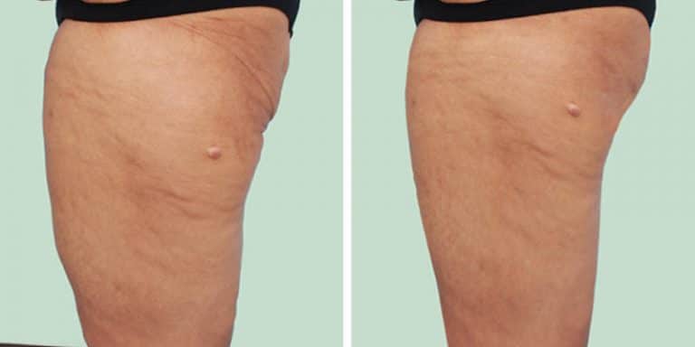 Thigh Lift Plastic Surgery Thailand